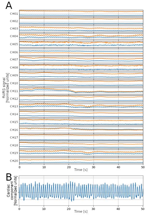 Performance Assessment of Heartbeat Detection Algorithms on ...