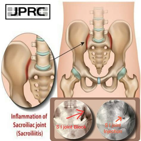 Sacroiliac Dysfunction Sacroiliac Joint | Palomar Health | San Diego