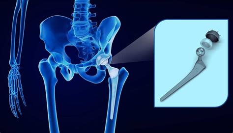 ¿Qué es una fractura de cadera? — Teletype