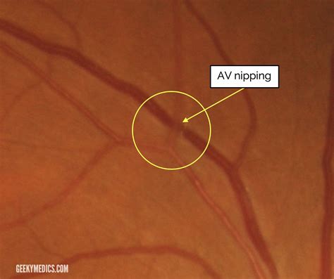 Fundoscopic Appearances of Retinal Pathologies | Geeky Medics