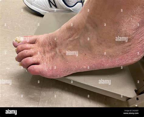 Athlete's foot in a 65 year old white male patient. Athlete's foot, or tinea pedis, is a form of ...