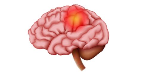 Stroke Management | SAKSHAM LMIS - NIHFW