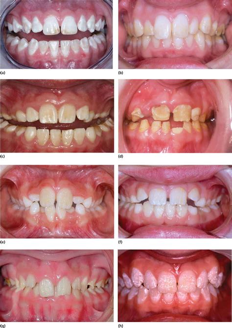 20: Developmental Defects of the Dental Hard Tissues and their ...