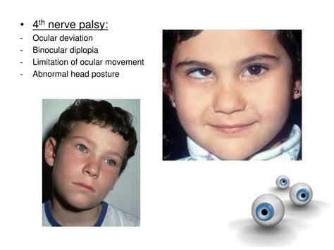 PPT - Strabismus PowerPoint Presentation, free download - ID:8768938