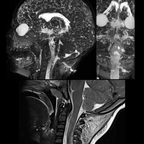 Cerebrospinal Fluid Leak 2025 File Updates & Releases #974