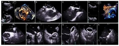 Multimodality Imaging in the Study of the Left Atrium