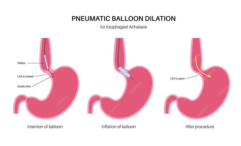 Endoscopy Upper Esophageal Sphincter at Lilly Minns blog