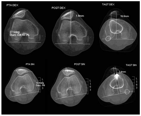 Medial Patellofemoral Ligament and Lateral Patellofemoral Ligament ...