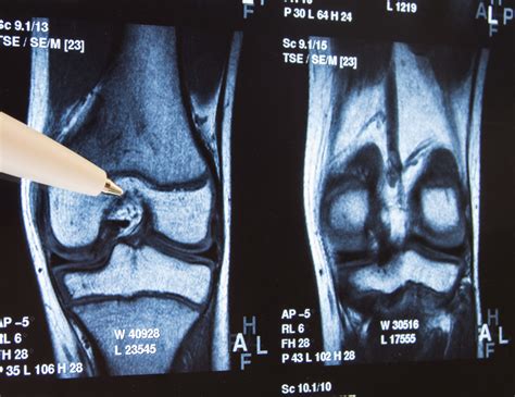 The painful and debilitating condition that is arthritis