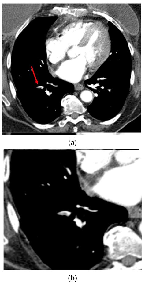 Deep Learning-Based Algorithm for Automatic Detection of Pulmonary ...