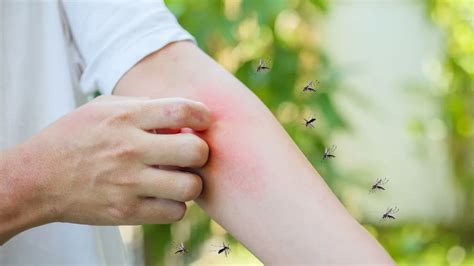 Can A Mosquito Bite Mean More Than Just Rashes And Allergies? Doctor ...