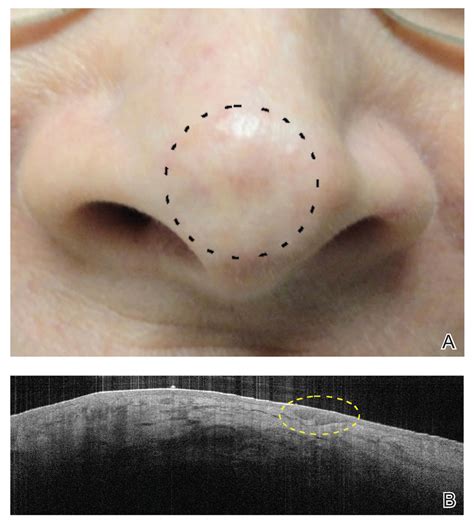 Basal Cell Carcinoma Superficial Multifocal Type Treatment - Infoupdate.org