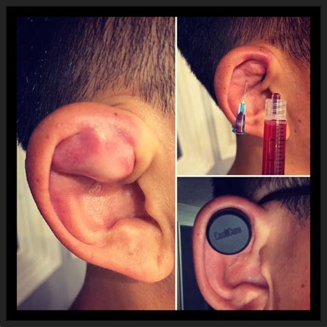 How to use Caulicure for the Treatment and Prevention of Cauliflower E