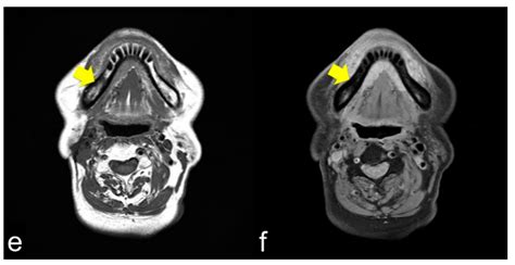 Osteomyelitis Of Jaw Radiographic Features at Kenneth Mcgray blog