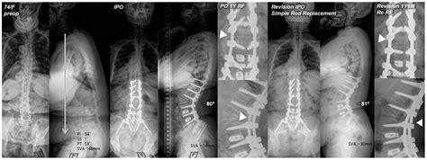 Comparison of Revision Techniques for Rod Fracture after Adult Spinal ...