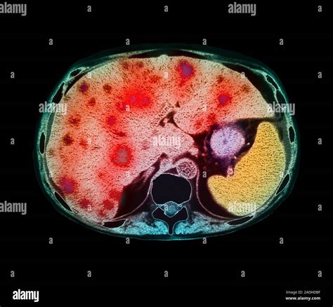 Liver cancer. Coloured computed tomography (CT) scan of an axial section through the human ...