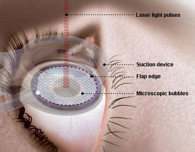 Laser eye surgery doesn’t harm cornea | TopNews
