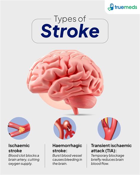 Stroke: Causes, Symptoms, and Treatments Guide