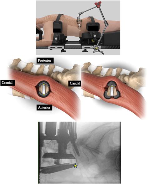 Prone Transpsoas Lateral Interbody Fusion (PTP LIF) with Anterior ...