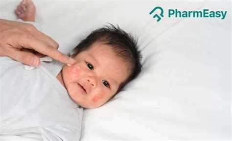 Baby Rash: Types, Treatment, Home Remedies & More | PharmEasy