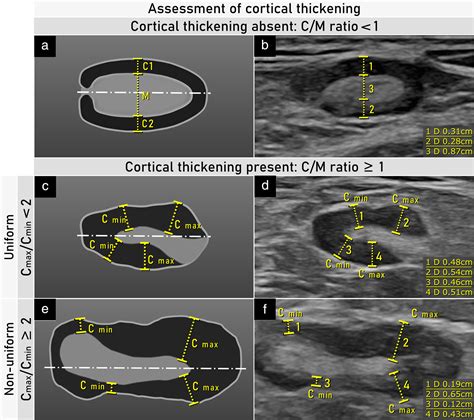 Terms, definitions and measurements to describe sonographic features of lymph nodes: consensus ...