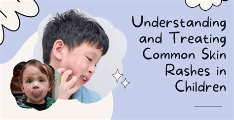 Understanding and Treating Common Skin Rashes in Children | Clinikally