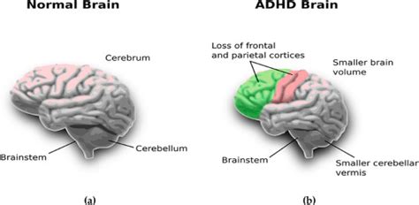 Image result for ADHD Brain Scan vs Normal