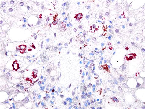 Pathology Outlines - Metabolic dysfunction associated steatotic liver disease (MASLD ...