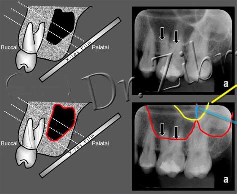 Maxillary Sinus & Molar Roots Relationship