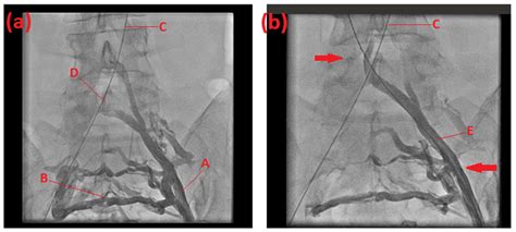 Familiar Disposition of May–Thurner Syndrome—A Case Series