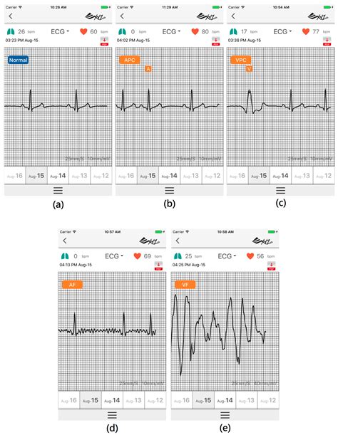 Arrhythmia Evaluation in Wearable ECG Devices