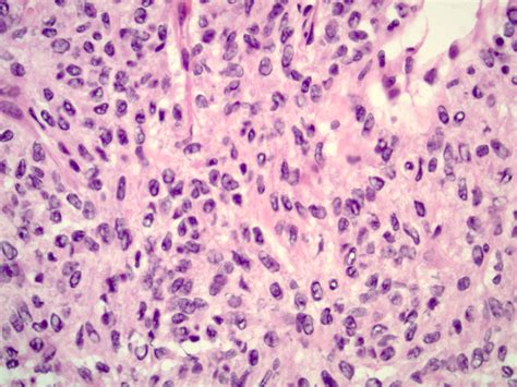 Pathology Outlines - Granulosa cell tumor-adult