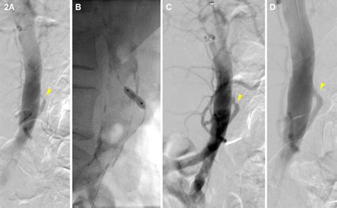 Inferior Mesenteric Artery Revascularization Can Supplement Salvage of Mesenteric Ischemia ...