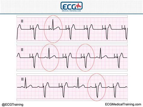 Ventricular Paced Rhythm Solved 35. Rhythm Interpretation . Interpret