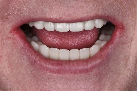 Implant retained full reconstruction - Nundah Village Dental