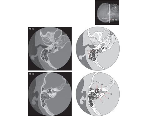 CT Temporal Bones.03 (Axial) Quiz