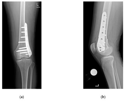 Reflections on Rotational Osteotomies around the Patellofemoral Joint