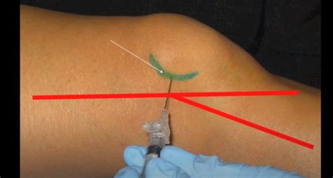 Image result for Ankle Anterolateral Approach Injection