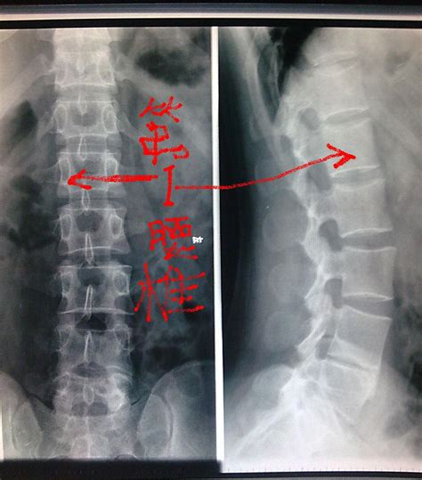 腰椎核磁片子上出现“黑间盘”意味着什么呢？-中国健康