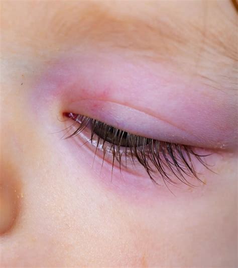Redness Around Baby’s Eyes: Causes, Remedies & Treatment
