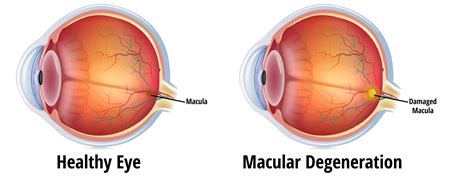 Image result for Macular Degeneration Vision Examples