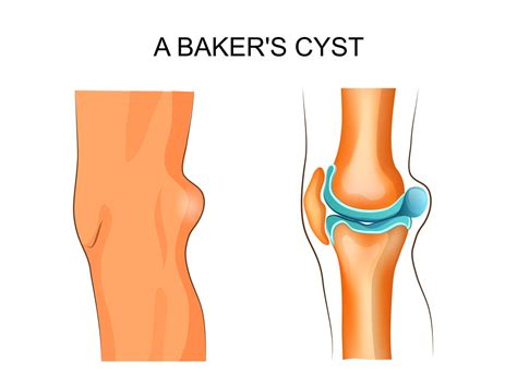 Baker’s Cyst, Causes and Treatment - Direct Orthopedic Care