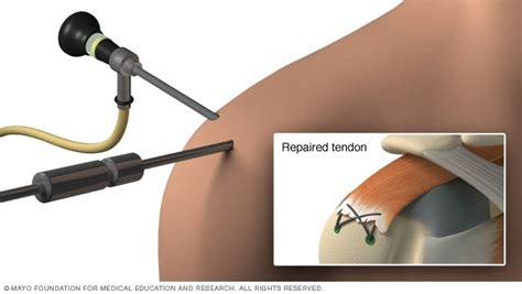 Image result for Rotator Cuff Repair Photo
