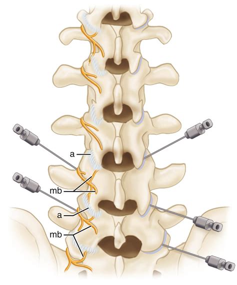 Degenerative Disorders of the Thoracic and Lumbar Spine - Clinical Tree