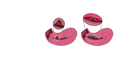 Isthmocele (Cesarean Scar Defect): Symptoms, Diagnosis, & its Impact on ...