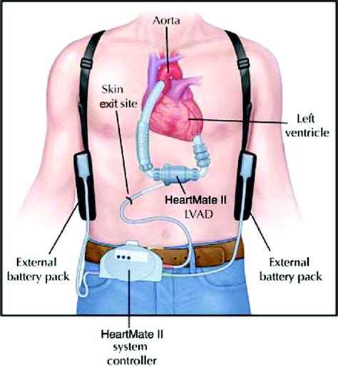 Left Ventricular Assist Device (LVAD) – How Does It Work?