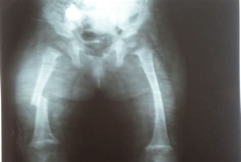 Spectrum of metabolic bone disease - a case series | Pediatric Oncall ...