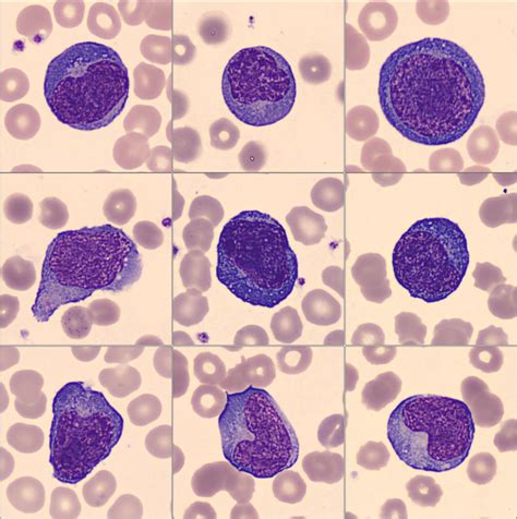 Atypical lymphoid cells circulating in blood in COVID-19 infection ...