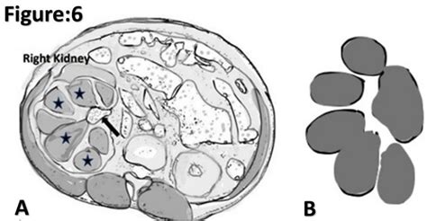 Role of Imaging in Renal Infections: A Narrative Review[v1] | Preprints.org