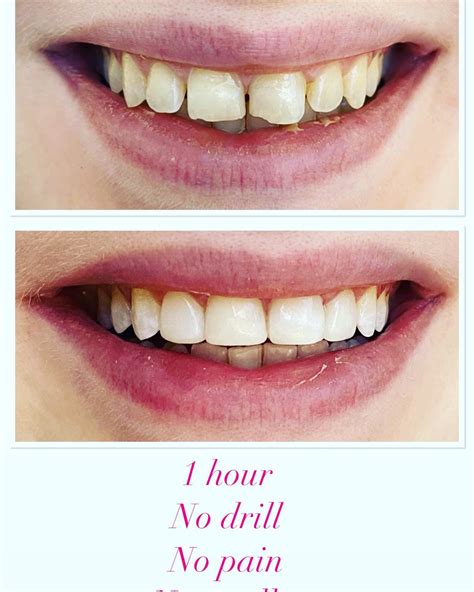 Composite Bonding Before and After - Shirland Dental Practice | Dentist in Maida Vale, London